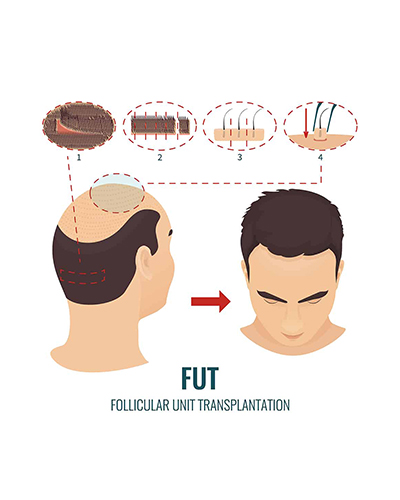 کاشت موی سر به روش FUT در تهران